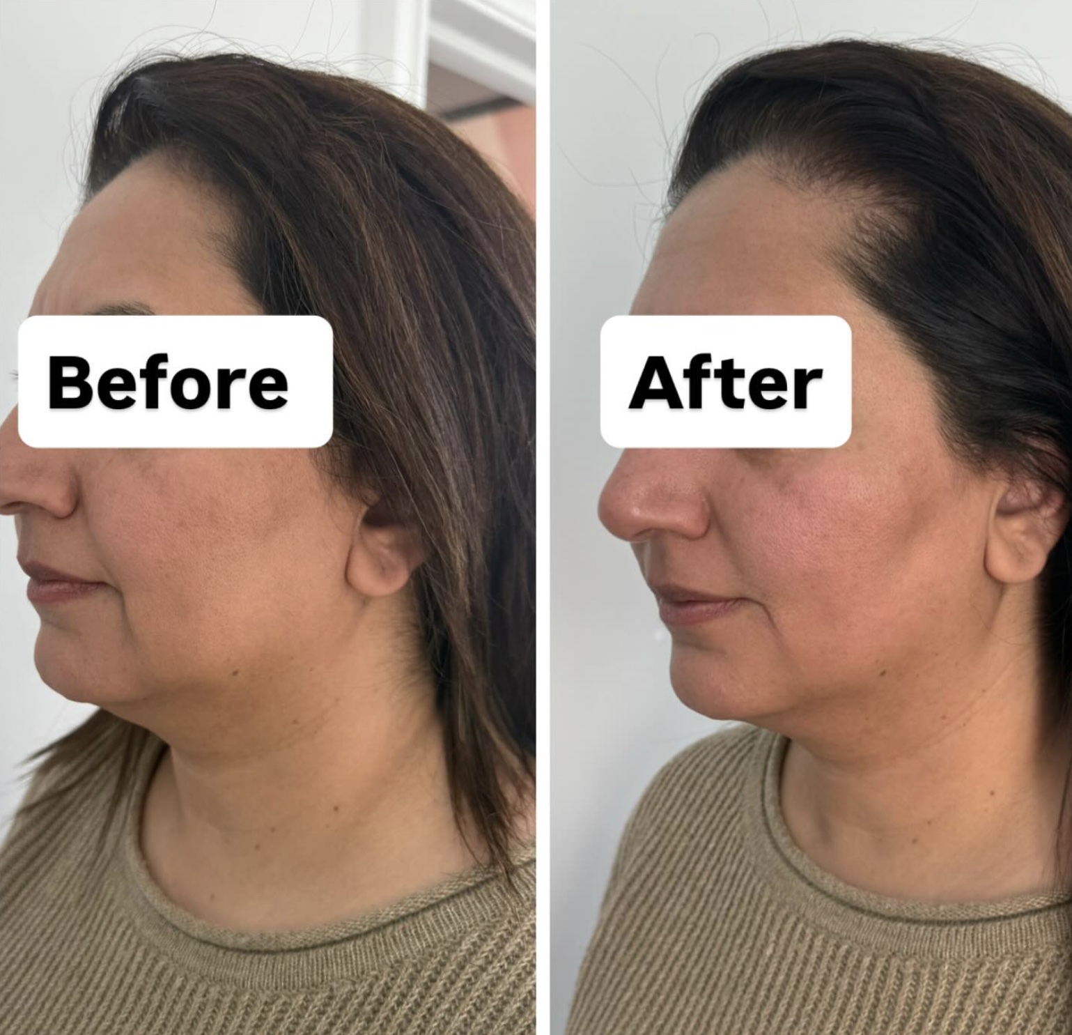 Advanced Skin Rejuvenation at Spoil Me Med Spa