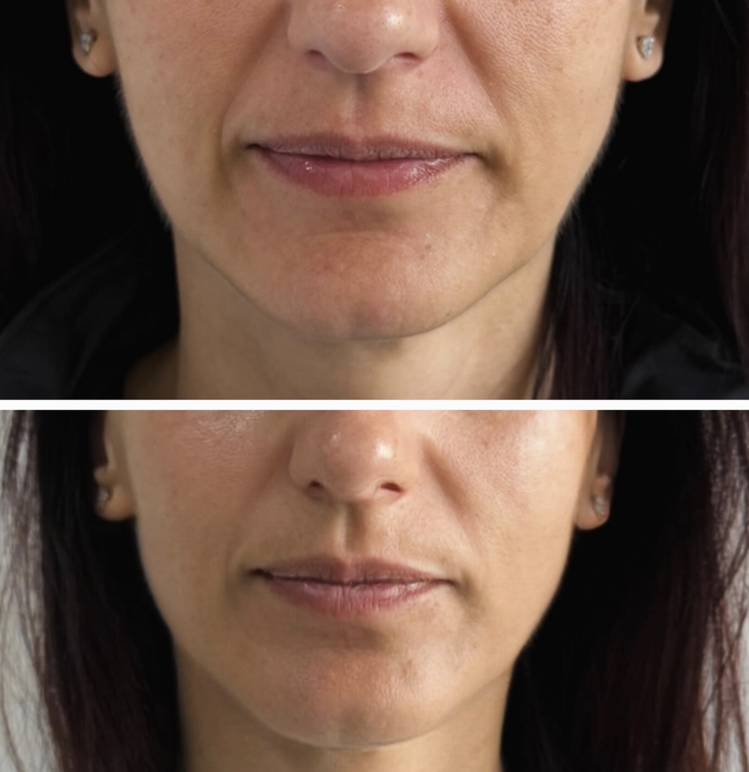 Aesthetic treatment result shared by the spa